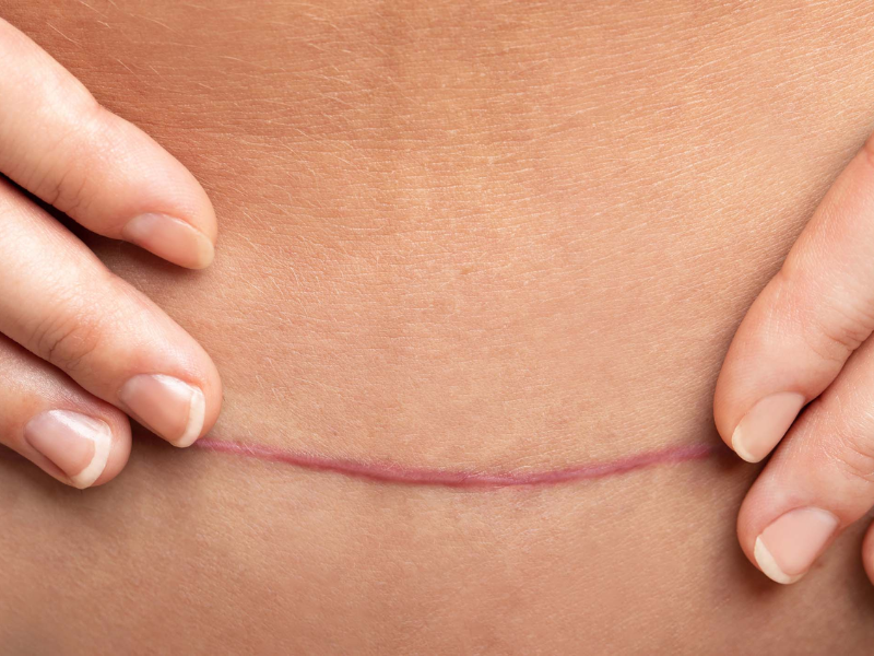 Como cuidar do corte da abdominoplastia: guia completo de cicatrização — Conquiste a barriga dos seus sonhos com segurança