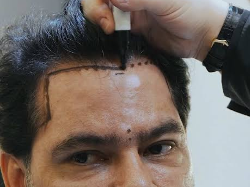 técnica no shave transplante capilar o que é