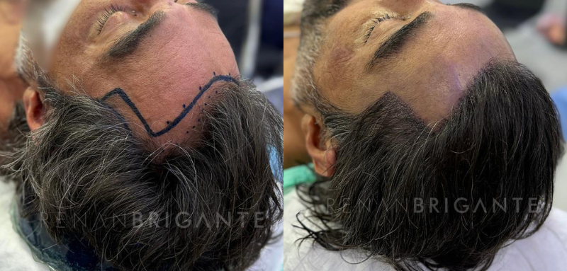 No Shave FUE ou FUE convencional: qual técnica faz mais sentido para você?
