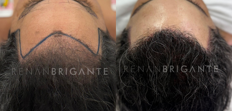 Clínicas de Transplante Capilar Sem Cirurgia: O Que Você Precisa Saber Antes de Decidir