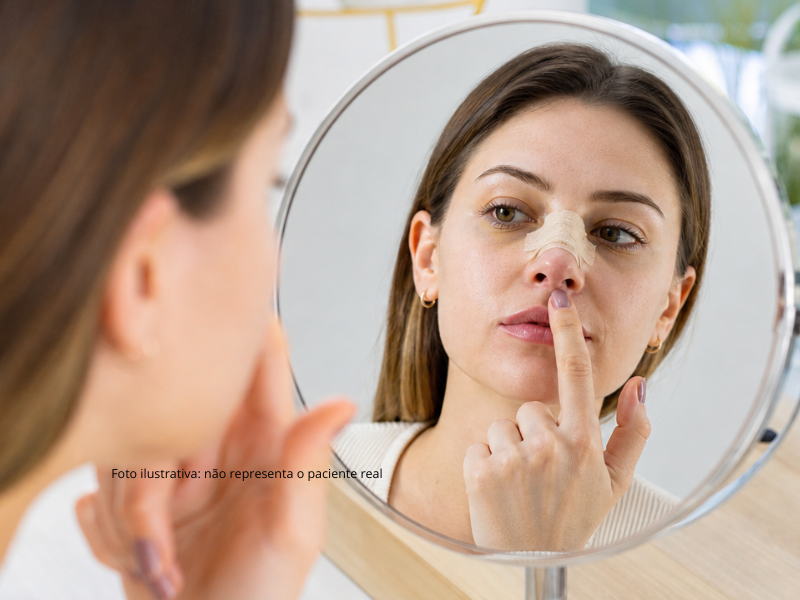 Pós-operatório da rinoplastia: o que esperar e como cuidar da recuperação