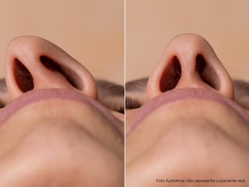 Quanto custa uma cirurgia de desvio de septo: o que considerar antes de decidir — Quanto custa uma cirurgia de desvio de septo: fatores que influenciam o valor