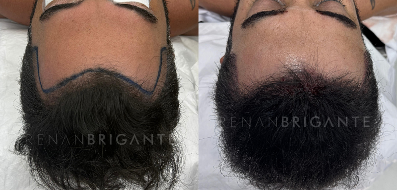 Transplante capilar natural: os detalhes que fazem a diferença no resultado