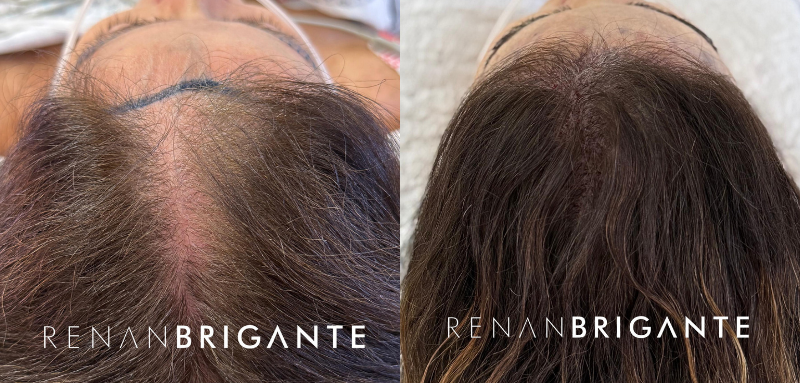 Transplante capilar natural: os detalhes que fazem a diferença no resultado