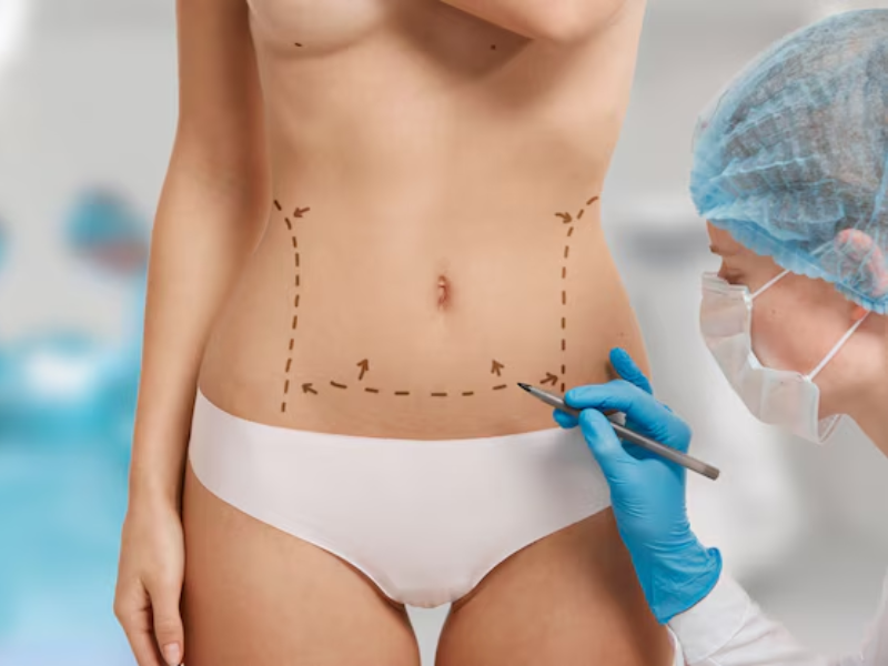 Cicatriz do mommy makeover: o que esperar e como cuidar — Cicatriz do mommy makeover: onde ficam e como são?