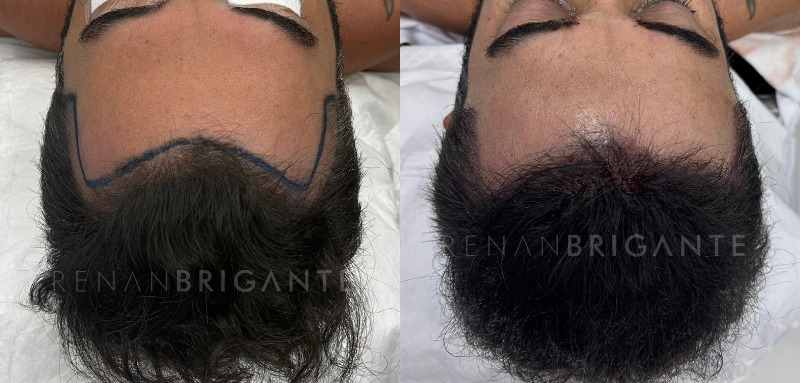 Transplante capilar sem raspar o cabelo: como funciona