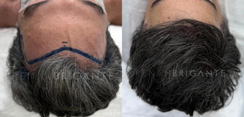 Transplante capilar sem raspar o cabelo: como funciona e para quem é indicado