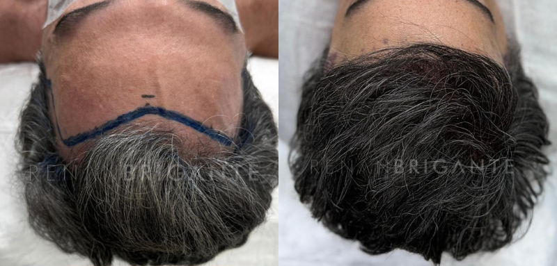 Transplante Long Hair FUE: Estética Desde o Primeiro Dia