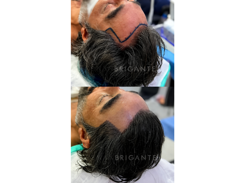 Preço do transplante capilar: o que influencia o valor e como avaliar o custo-benefício — Como avaliar o custo-benefício real do procedimento