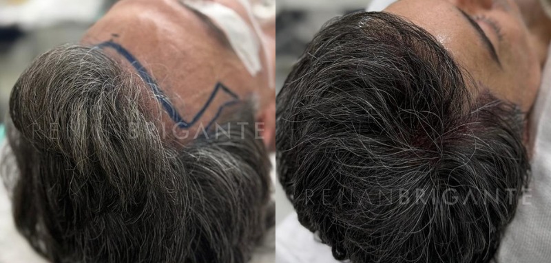 transplante capilar sem cortar o cabelo - Conheça as técnicas