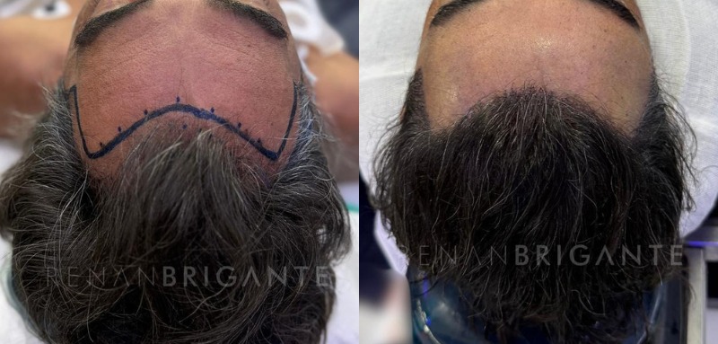 transplante capilar sem cortar o cabelo - recuperação