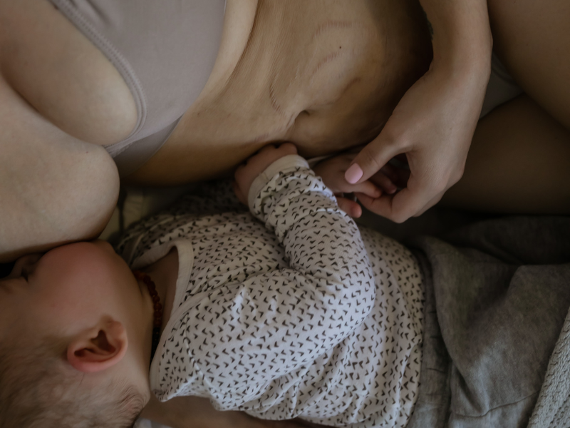 Recuperação do mommy makeover: o que esperar em cada fase do pós-operatório — Recuperação do mommy makeover: como é a evolução semana a semana?